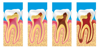 Traitement des caries